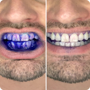 Pogromca płytki nazębnej